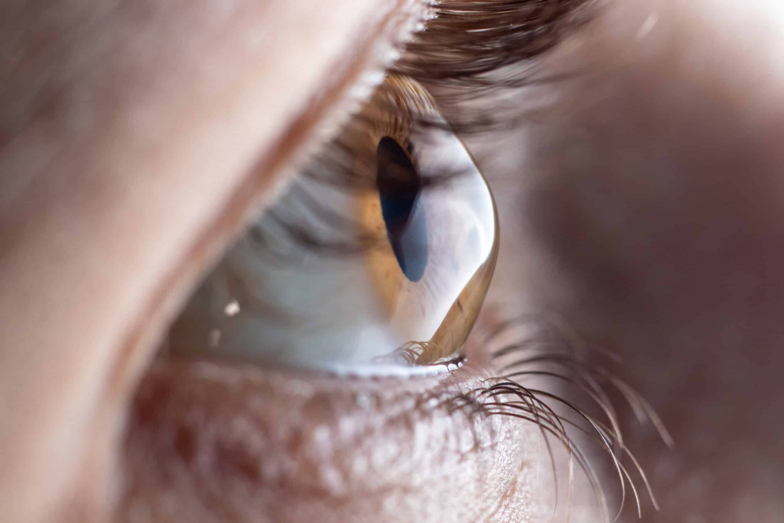 Macro eye photo. Keratoconus eye disease, thinning of the cornea in the form of a cone. The cornea plastic