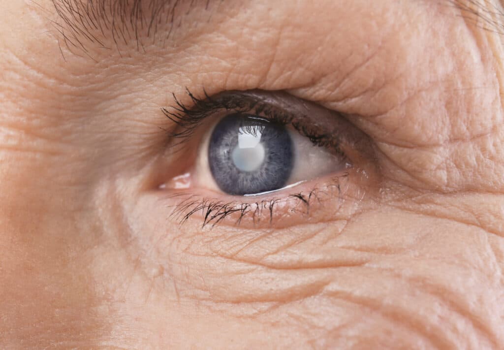 Cataract surgery at Tower Clock Eye Center