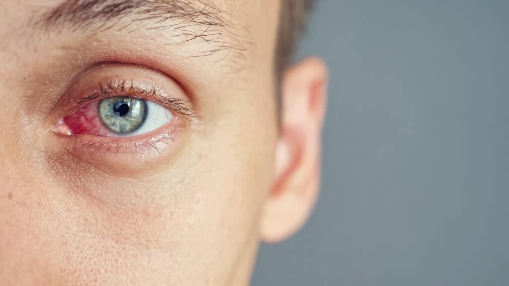 Allergies or dry eye? Let Tower Clock Eye Center help!