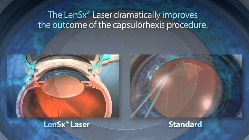 Cataract Surgery Consultation Documents Online