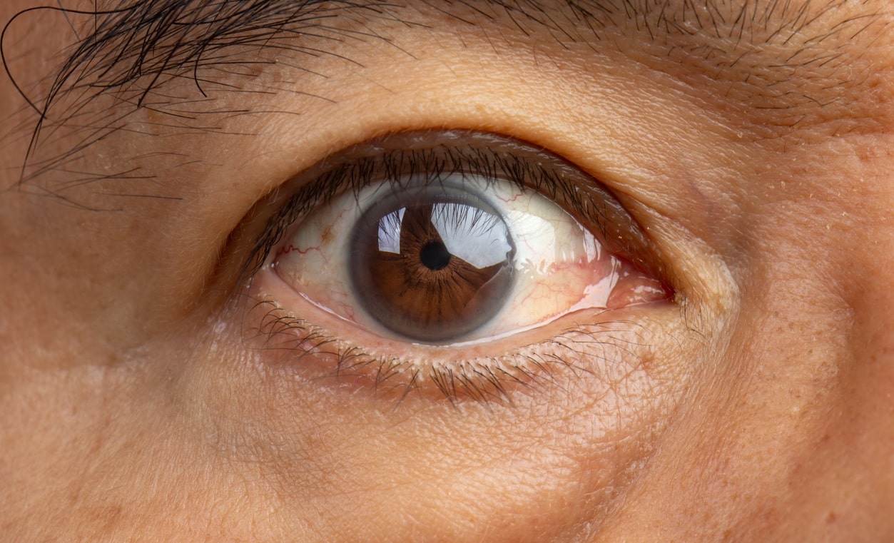 Entropion and Ectropion Repair