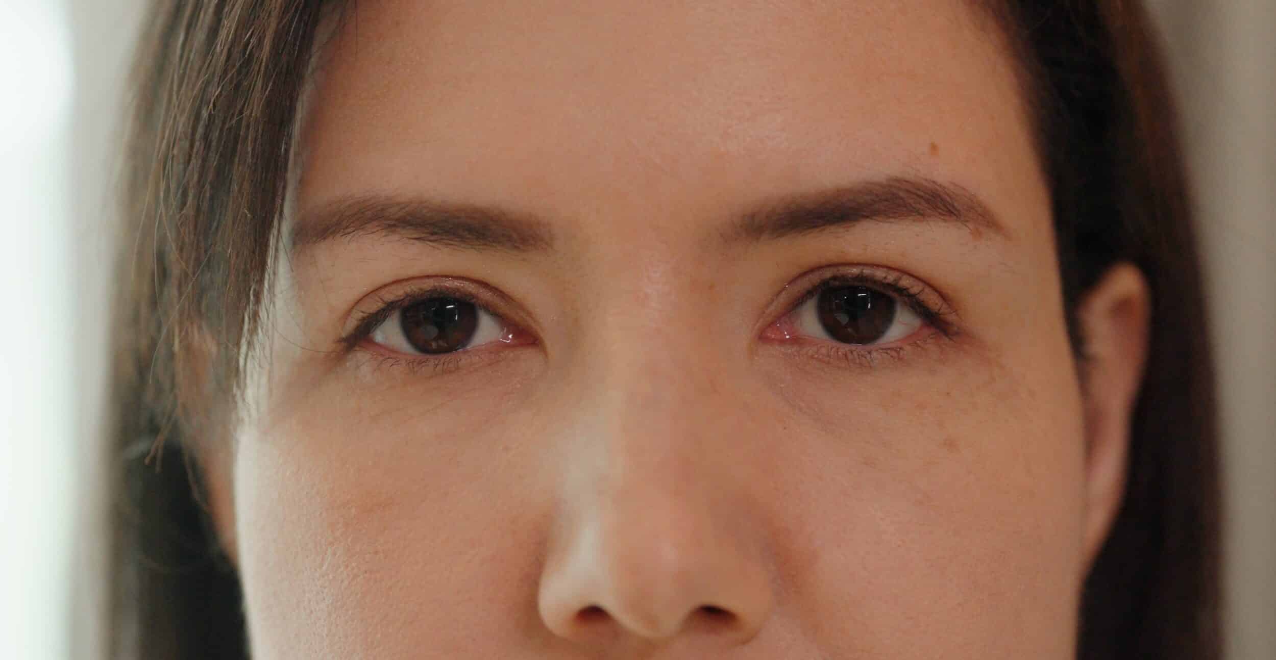 Ptosis (Drooping Eyelid) Repair